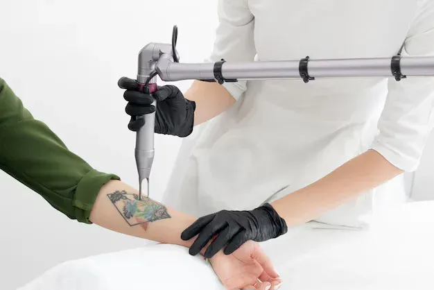 Tattoo remover